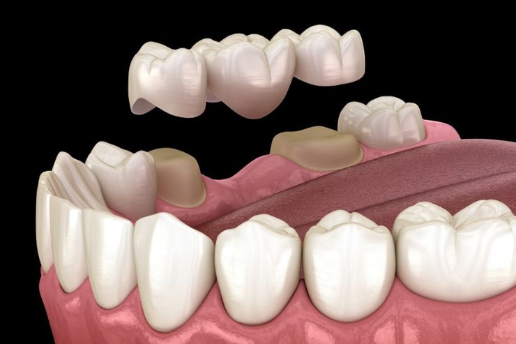 Dental Bridges