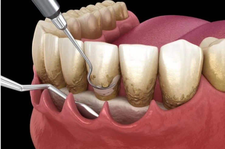 Periodontics