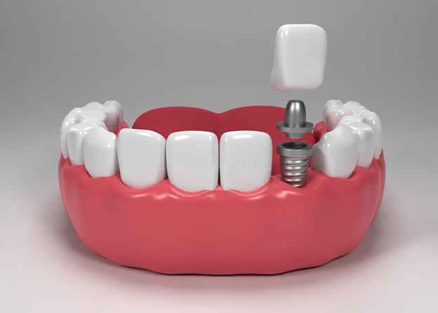 Dental Implants: A Game-Changer for Your Smile