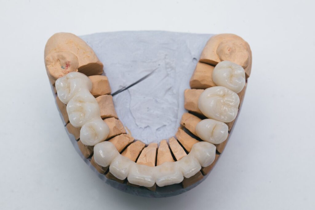 What are Dental Bridges?